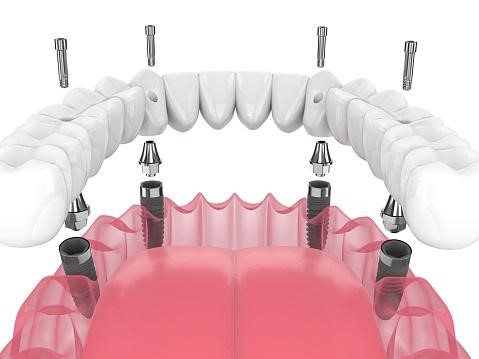 Dental Implants in Dubai