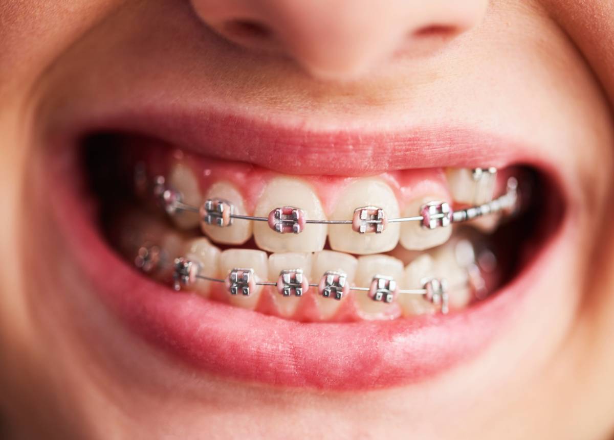 ceramic dental braces in Dubai