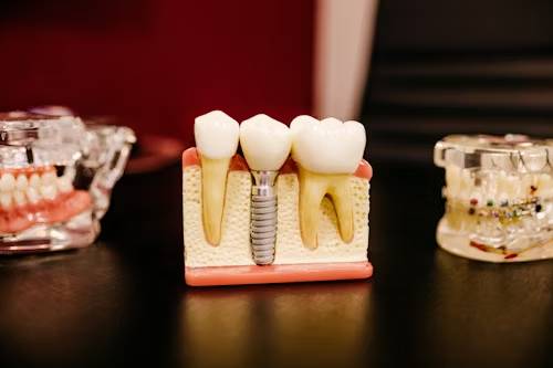 dental implants in Business Bay