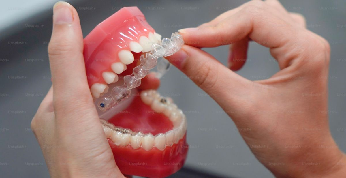 invisible aligners