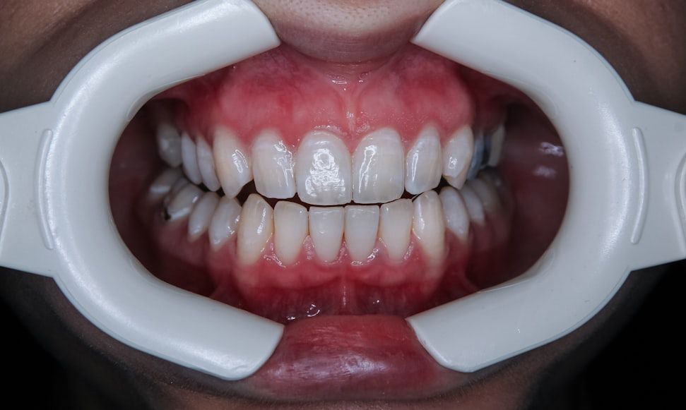 zoom teeth whitening in dubai