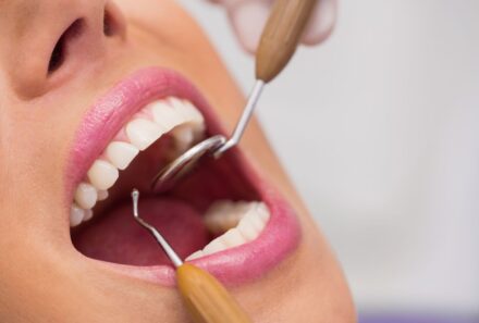 Teeth Whitening in Dubai: Everything You Need to Know For a Brighter Smile
