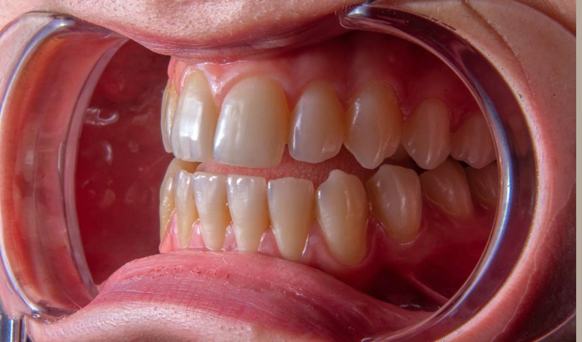 Gum Disease Treatment 