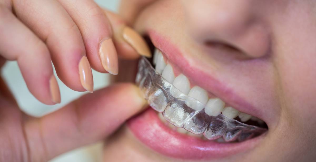 Invisible Braces & Clear Aligners