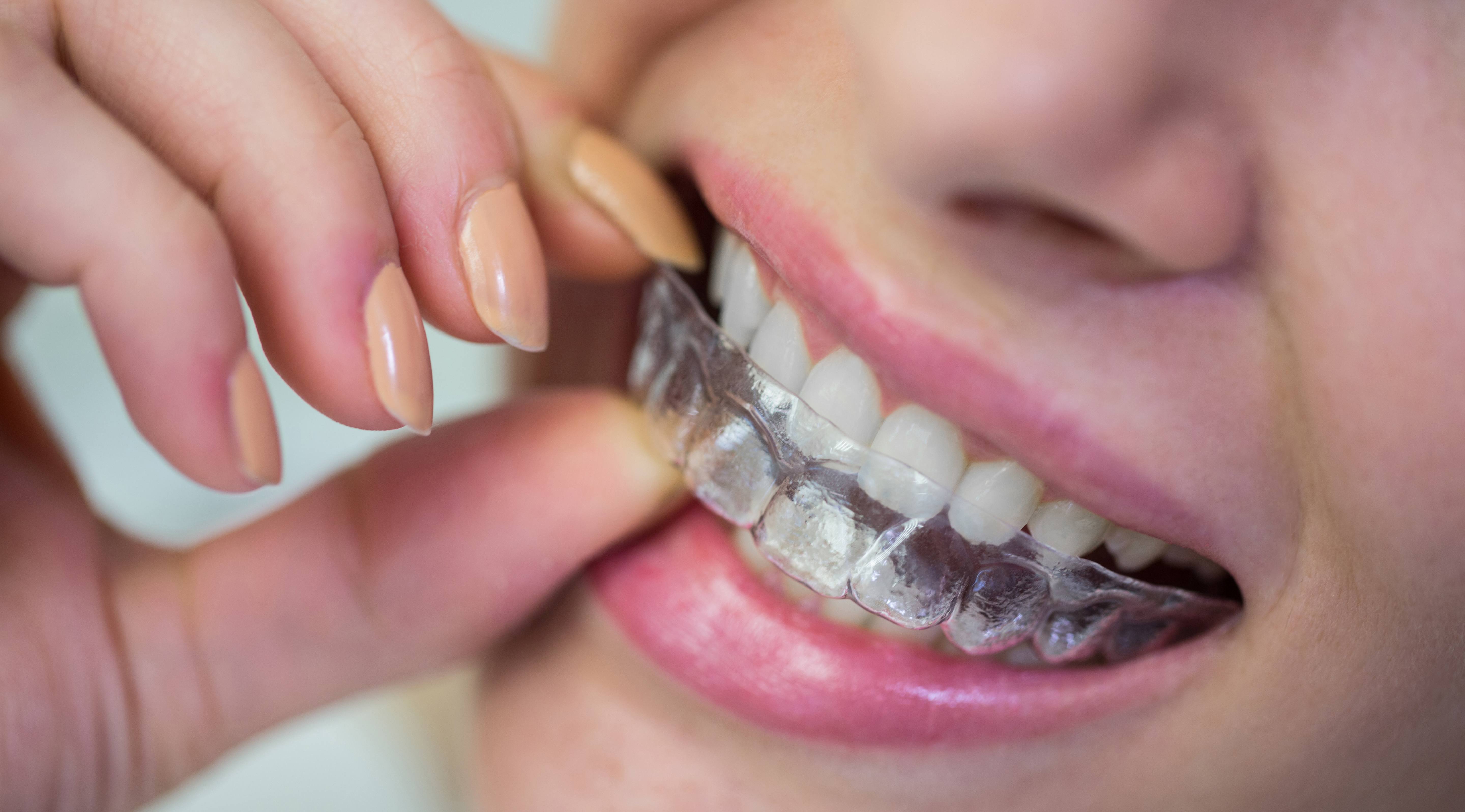 cosmetic teeth alignment in dubai