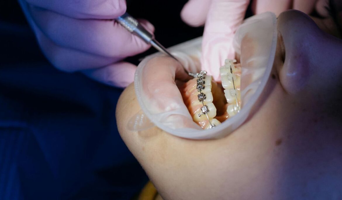 What to Expect During a Root Canal Treatment in Dubai At Bay Avenue Dental Clinic – A Step-by-Step Experience