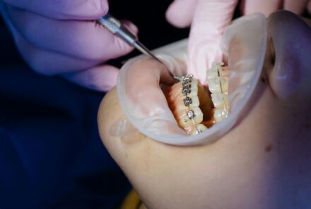 What to Expect During a Root Canal Treatment in Dubai At Bay Avenue Dental Clinic – A Step-by-Step Experience