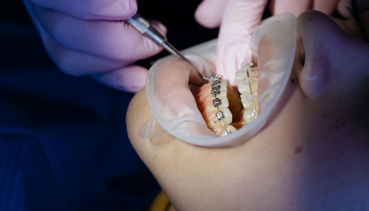 Lingual Braces, Ceramic Braces, or Invisalign? Complete 2025 Dubai Orthodontics Guide (Costs, Pros & Cons, Best Dental Clinics) 2 best orthodontist in UAE