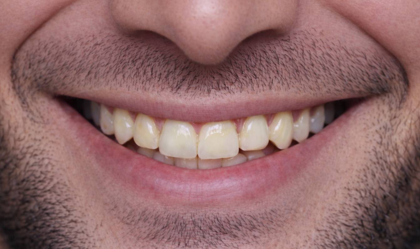 celebrity-veneers-hollywood-smile-veneers-before-treatment