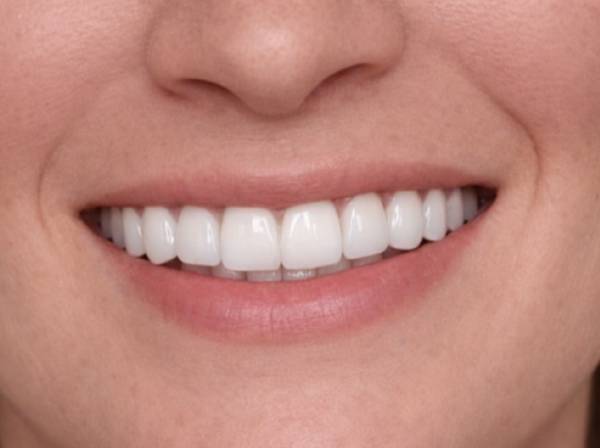 Dental Veneers in Dubai 8 ceramic veneers