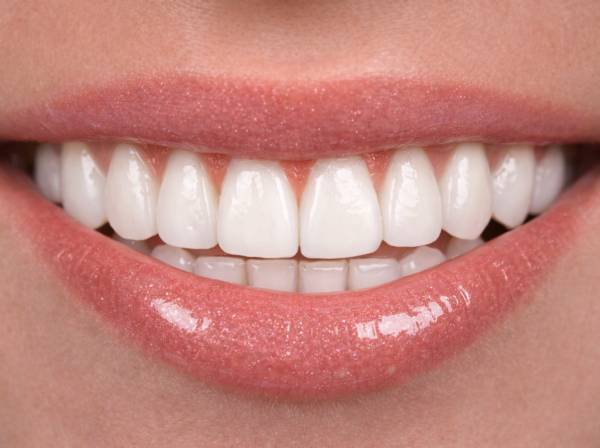Dental Veneers in Dubai 6 composite veneers