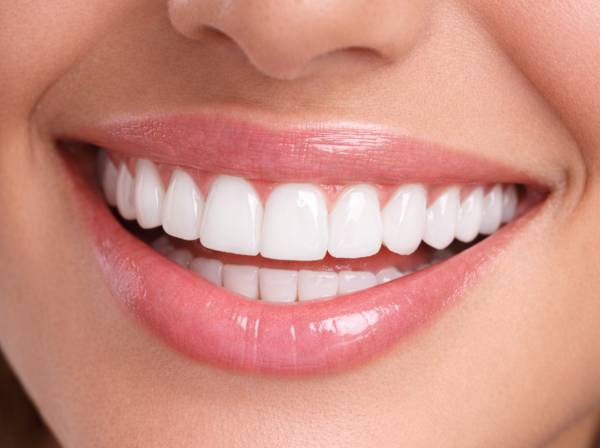Dental Veneers in Dubai 5 emax veneers