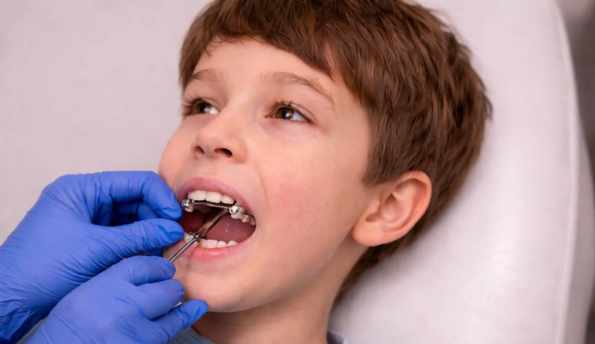 Bite Correction Treatment in Dubai: Overbite vs Underbite vs Crossbite (How Each Is Fixed) 2 jaw alignment orthodontist