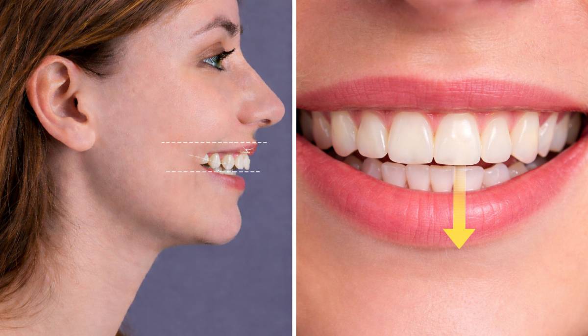 Bite Correction Treatment in Dubai: Overbite vs Underbite vs Crossbite (How Each Is Fixed) 1 jaw and teeth alignment