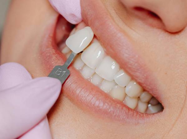 Dental Veneers in Dubai 7 no prep and minimal prep veneers