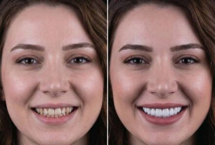 Dental Veneers in Dubai: Types, Costs & Natural Smile Results for 2026