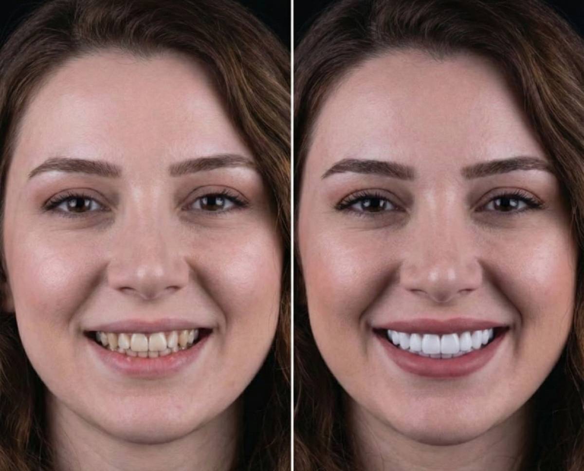 Dental Veneers in Dubai 1 smile makeover with veneers in dubai bay avenue