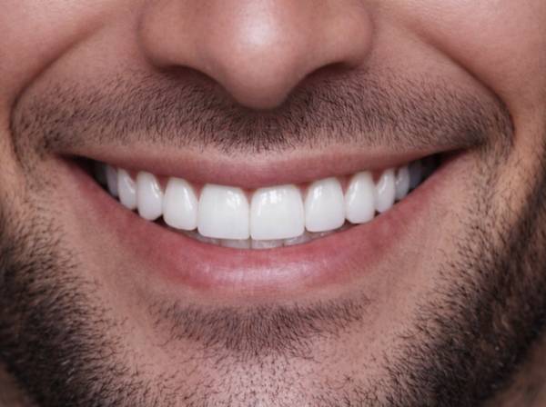 Professional Teeth Whitening Dubai 10 teeth whitening in business bay