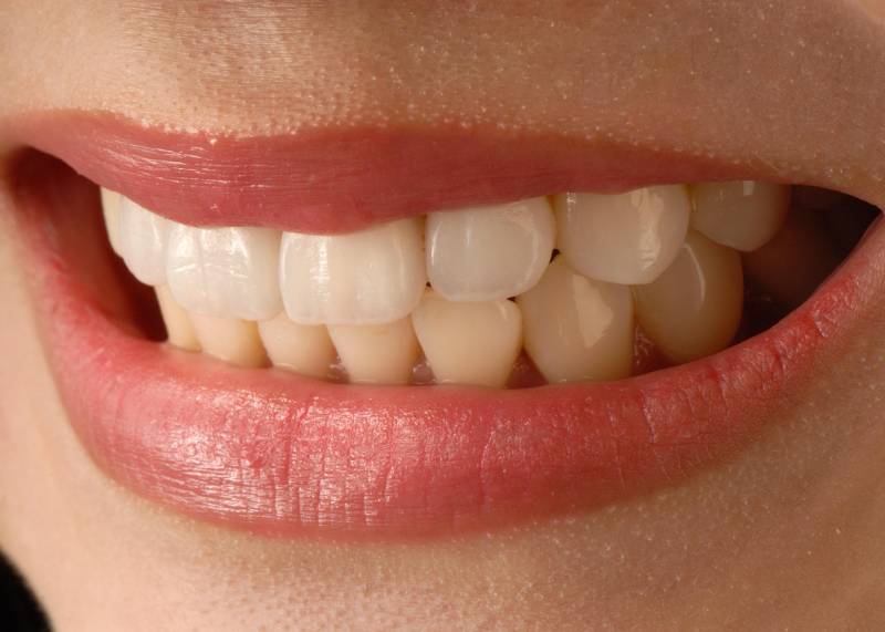Dental Veneers in Dubai 3 who should consider dental veneers