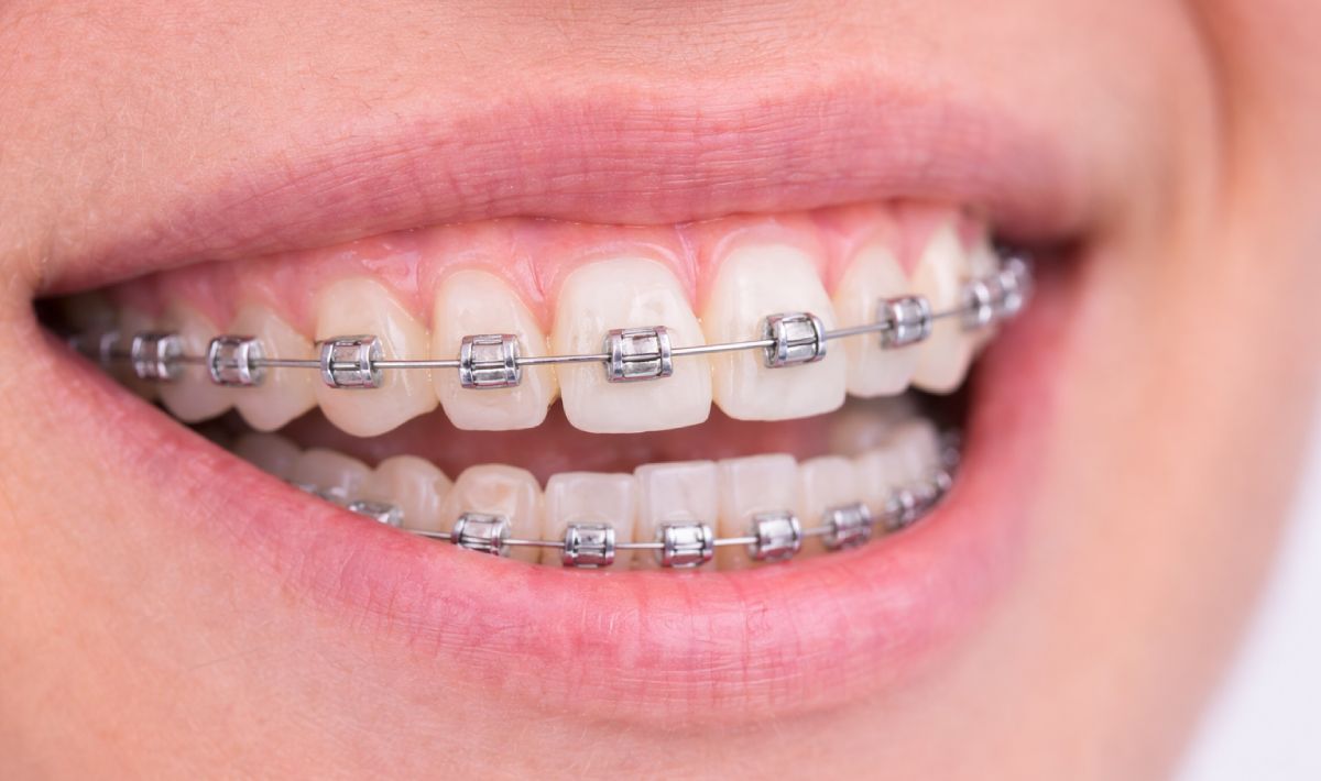 Crowded Teeth Treatment in Dubai: Braces vs Clear Aligners (Which Works Better for You?) 2 metal braces in Dubai