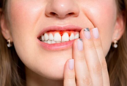 What is Gum Disease? Periodontal Disease Symptoms, Causes, Treatment, Prevention