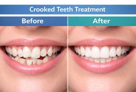 Crooked Teeth Treatment in Dubai: Causes, Options, and Right Treatment Options in 2026