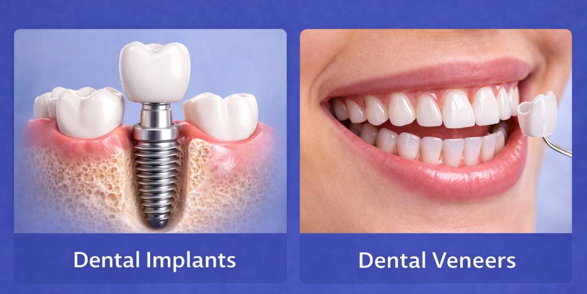 dental implants in Dubai 