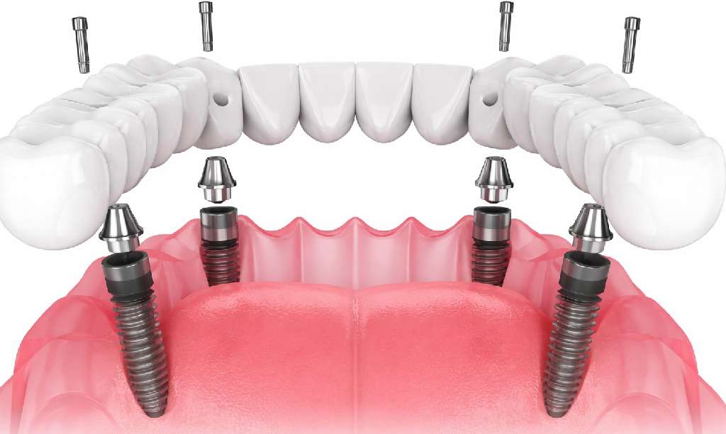 all on 4 dental implants