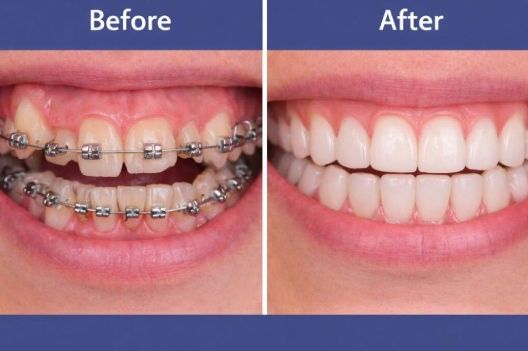 crowded teeth treatment in dubai 1 1