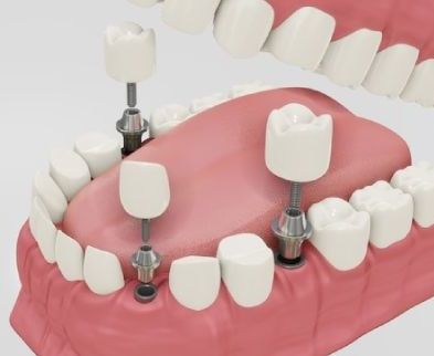 Same Day Dental Implants in Dubai 4 dental implant 1 2