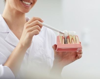 Same Day Dental Implants in Dubai 3 dental implant 2 1