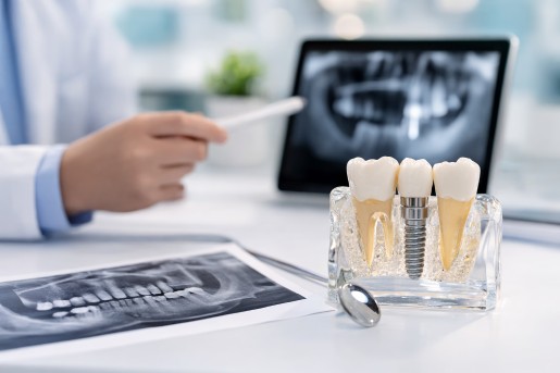 dental implant cost in dubai