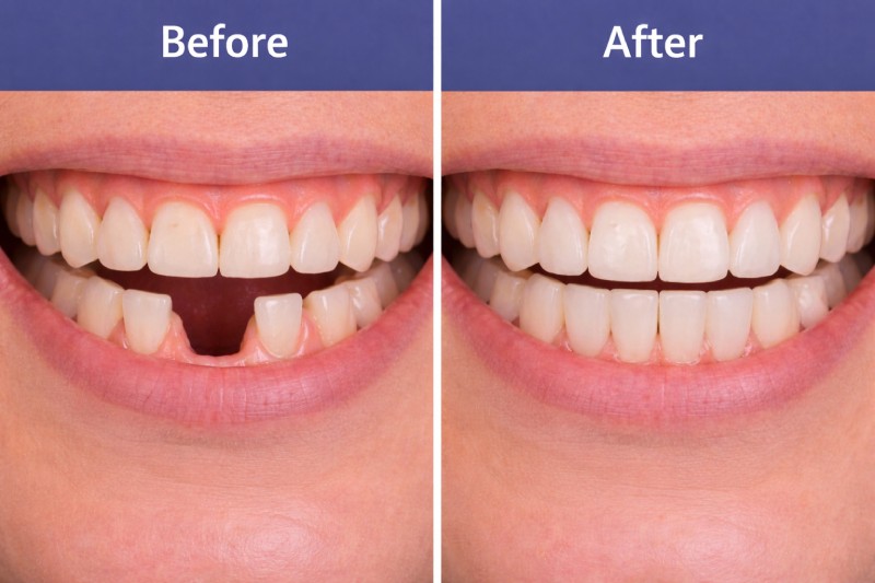 dental implant cost per tooth in dubai