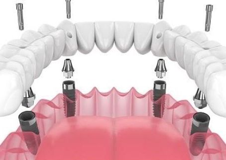 Same Day Dental Implants in Dubai 6 dental implant img1 1