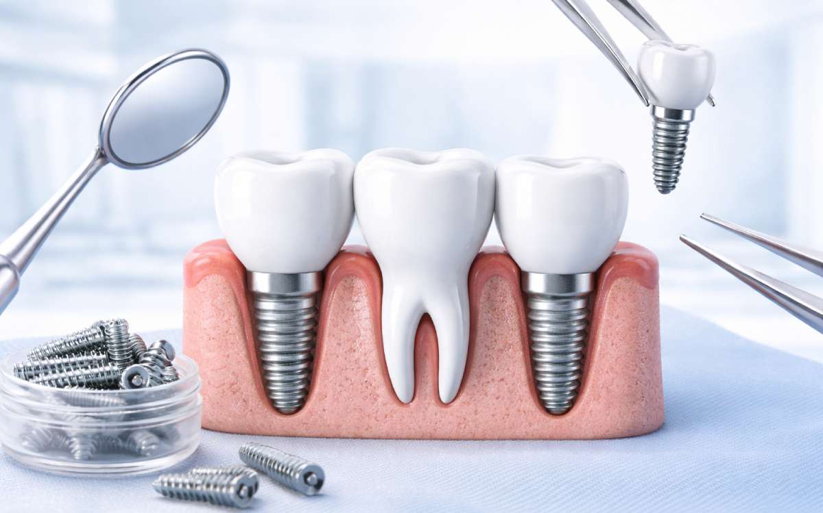 How Long Do Dental Implants Last? Lifespan, Success Rate & Maintenance 1 dental implant lifespan