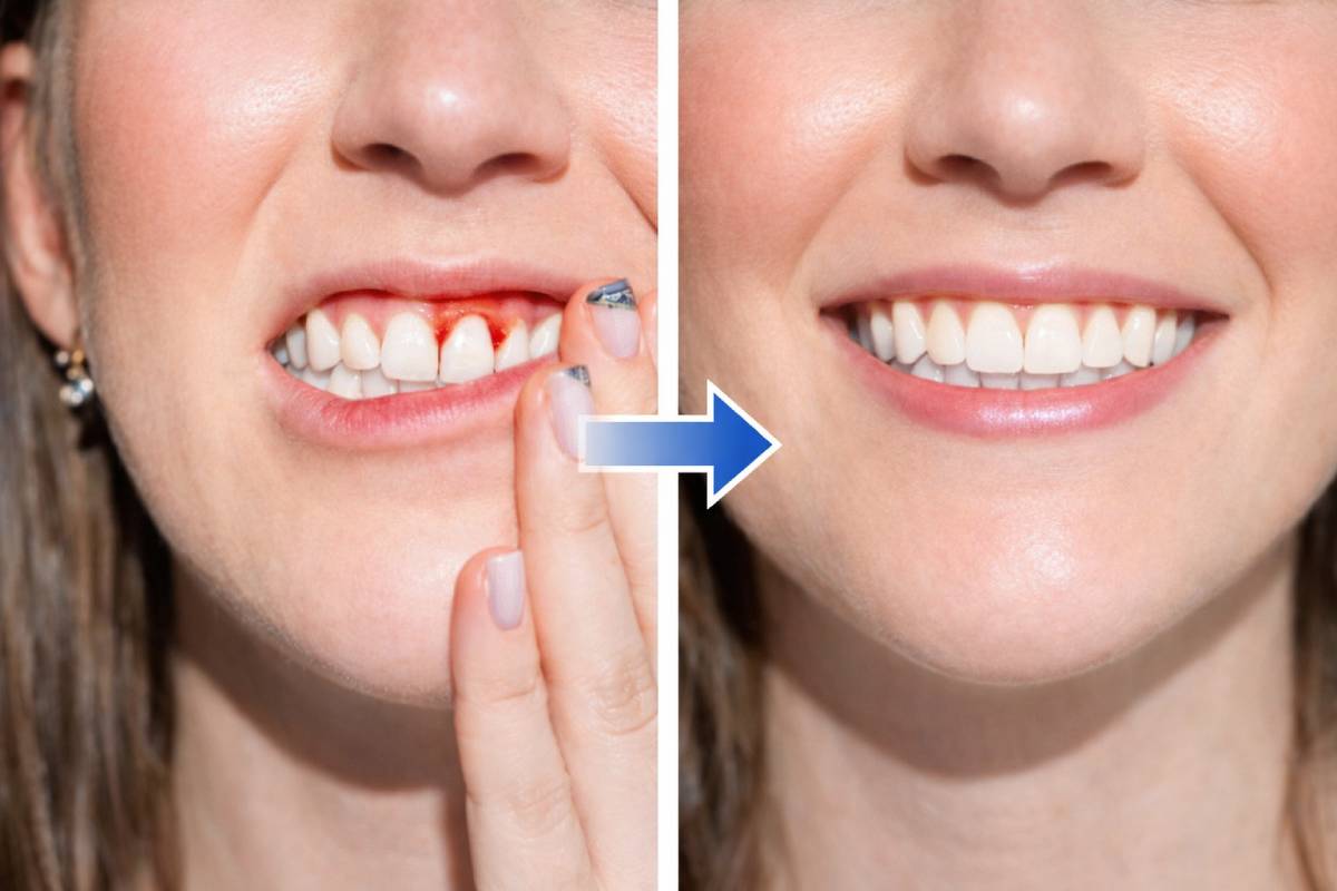 Dr. Alok Mehta 6 gum disease treatment