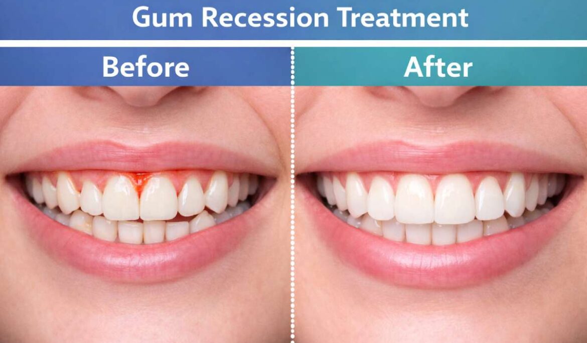 Gum Recession Treatment in Dubai: When You Need Gum Grafting