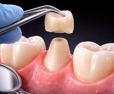 immediate temporary restoration