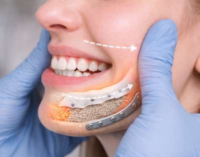 Dr. Chandan Prabhakar 5 jawbone reconstruction