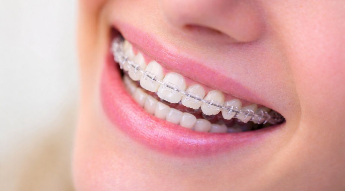Transparent Teeth Braces in Dubai: How Clear Braces Straighten Teeth Discreetly 3 teeth braces transparent