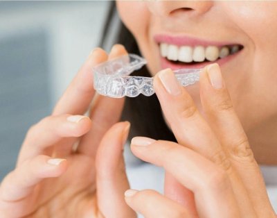 clear aligners