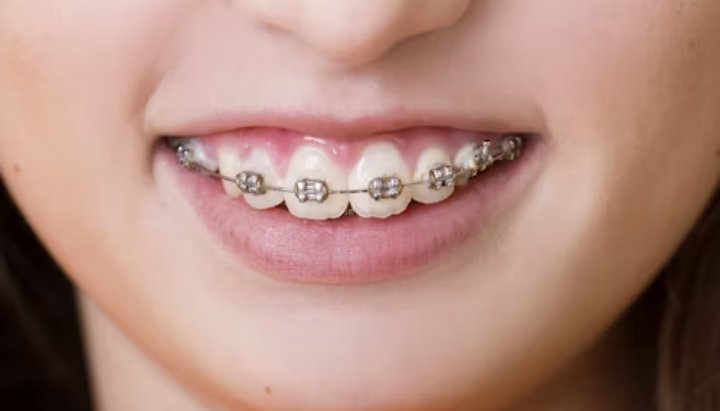traditional braces