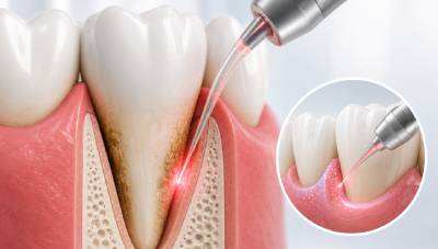 Gum Infection Treatment 4 laser disinfection