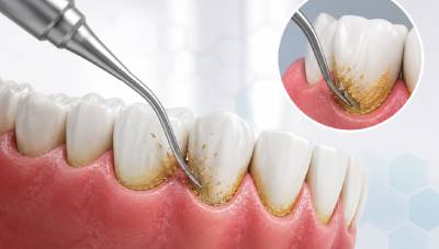 Gum Infection Treatment 2 professional scaling gum