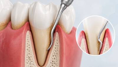 Gum Infection Treatment 3 root planing for deeper infection