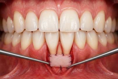 Gum Recession Treatment 3 connective tissue grafting treatment in dubai