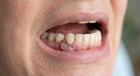 Gum Recession Treatment 4 free gingival grafting treatment