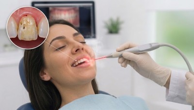 Gum Infection Treatment 4 laser disinfection