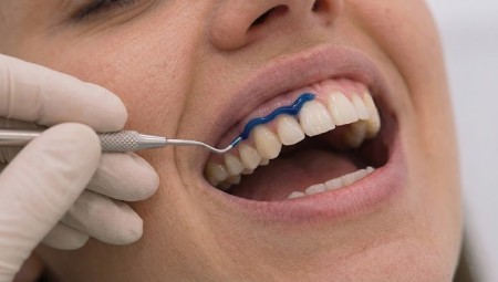 Gum Recession Treatment 5 non surgical stabilisation treatment